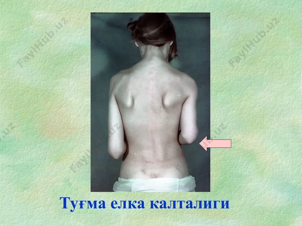 волаш букувчи контрактурани йўқотиш, сон суяги бошчасини тўғрилаш ва марказлаштиришдан иборат сон суяги туғма чиқишини даволаш мануал тўғрилаш (лоренц бўйича) скелет тортма қўйилиб, кейинчалик 6-8 дан 24 ойлигигача кокситли гипс боғлам билан иммобилизацияланади сон суяги туғма чиқишини даволаш оператив даволаш консерватив даво самара бермаганда ёки кеч ташхис қўйилганда амалга оширилади. туғма маймоқоёқлик оёқларда энг учрайдиган туғма нуқсон -12% ўғил бола: қиз бола = 2:1 кўпроқ ўнг томонлама генетик мойиллик бўлиши мумкин туғма маймоқоёқлик pes equinovaroexcavatus metatarsus adductus туғма маймоқоёқлик pes equinovaroexcavatus metatarsus adductus туғма маймоқоёқлик pes equinovaroexcavatus metatarsus adductus енгил даража. эквинус устунлиги билан туғма маймоқоёқлик pes equinovaroexcavatus metatarsus adductus metatarsus adductus туғма маймоқоёқлик pes equinovaroexcavatus metatarsus adductus диагностикаси маймоқоёқлик косолапость – pes eqvinovarus congenitalis – товон флексия, аддукция ва супинация ҳолатида бўлиб, товон учи ичкарига бурилган ҳолатда учрайдиган деформация. маймоқоёқлик : этиология кўпинча - идиопатик сабаби 25-40%холда аниқланади идиопатик маймоқоёқлик бошқа касалликларсиз учраса, мултифакториал наслдан-наслга ўтади. маймоқоёқлик : этиология …