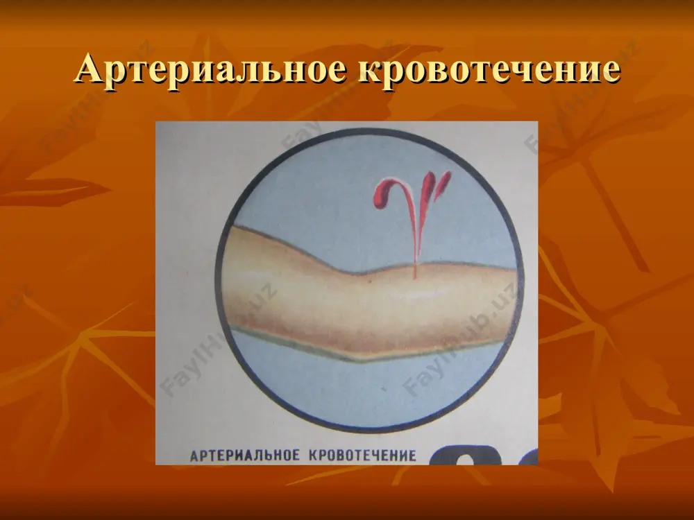 й материал). пальцевое прижатие сосуда к кости. наложение зажима на кровоточащий сосуд. максимальное сгибание конечности в суставе. наложение давящей повязки. приподнятие конечности. тампонада раны. пальцевое прижатие сосуда в ране наложение жгута ленточный жгут типичные места для прижатия артерий типичные места для прижатия артерий остановка кровотечения из области предплечья и кисти максимальным сгибанием в локтевом суставе максимальное сгибание конечности остановка кровотечения давящей повязкой возвышенное положение конечности для остановки кровотечения методы окончательной остановки кровотечения механические способы. термические способы. химические способы. биологические способы. способы механического метода остановки перевязка сосуда в ране. перевязка сосуда на протяжении. наложение сосудистого шва. давящая повязка. тампонада. перевязка сосуда в ране остановка кровотечения путем обшивания сосуда прошивание сосуда в ране перевязка сосуда иглой дешана перевязка сосуда на протяжении наложение сосудистого шва механический аппаратный сосудистый шов остановка кровотечения путем сшивания аллотрансплантата тампонада раны физические методы остановки кровотечения применение пузыря со льдом применение тампонов, смоченных с горячими антисептическими, изотоническими растворами электрокоагуляция …