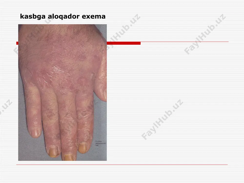 lliklarni davolash sutli –usimli diyeta degelmentizaciya mehnat charoitlarini yachshilash atopik dermatit nasldan utadigan alllergik dermatoz surunkali kechuvchi ,qaytalanuvchi dermatoz . qichishish ,eritema ,tugunchalar paydo buladi , liheniszaciya eshak emi utkir va surunkali kechuvchi birlamchi toshma – urtika differencial diagnoz –dermatit duringa bilan eshak emi neyrodermit surunkali kechuvchi terining yalliglanishi . bu kasallikda eritematoz –lichenoidli toshmalar paydo buladi , bir biri bilan qushilgan. papulez infiltraciya uchoqlari paydo buladi va kup toshadigan joylarda lihenizaciya kuzatiladi neyrodermit turlari chegaralangan diffuz uchta zona markaziy (lihenizaciya ) urta (papulez ) periferik (giperpigmentaciya) qiyesiy tashhis (surunkali kechuvchi exema, qishima) qichima surunkali kechuvchi dermatoz –tugunchalar hosil buladi turlari : bolalar qichimasi (strofulus ) kattalar qichimasi tugunli qichima differencial tashhis –neyrodermit , kpl davolash komplexli asab, asab endokrin uzgarishlarni davolash infekciya uchoqlarini sanaciyasi gipoallergik diyeta sedativ vositalar giposensibilizacion terapiya immunokorregent vositalar the subject: dermatitis, toksikodermia, eczema, itching dermatosis, urticaria. dermatitis, inflammation of the skin, caused by direct impact …