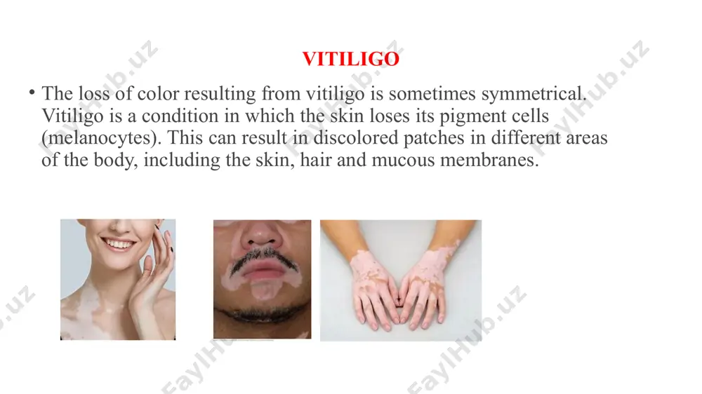 ypomelanosis tinea versicolor tuberculoid leprosy diagnosis an ultraviolet light can be used in the early phase of this disease for identification and to determine the effectiveness of treatment. using a wood's light, skin will change colour (fluoresce) when it is affected by certain bacteria, fungi, and changes to pigmentation of the skin. dr munir (dm) - treatment there is no cure for vitiligo but several treatment options are available.the best evidence is for applied steroids and the combination of ultraviolet light in combination with creams. due to the higher risks of skin cancer, the united kingdom's national health service suggests phototherapy be used only if primary treatments are ineffective. lesions located on the hands, feet, and joints are the most difficult to repigment; lesions on the face are easiest to return to the natural skin color as the skin is thinner in nature. treatment immune mediators topical preparations of immune …