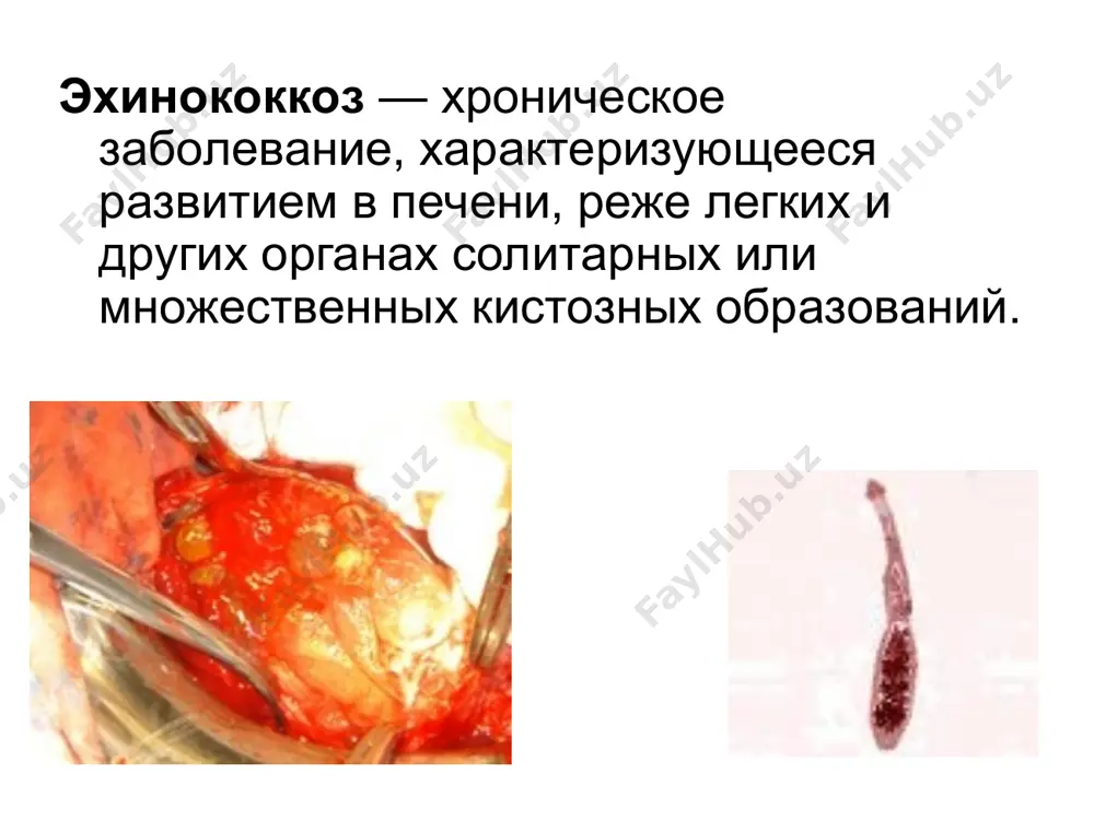 рной областях, похудание, одышку, сердцебиение и головные боли; отдельные больные отмечают высыпания крапивницы. окраска кожи и слизистых оболочек обычно нормальная или бледная, у отдельных больных имеется субиктеричность склер и даже выраженная желтуха. печень, как правило, увеличена, уплотнена и болез­ненна, иногда на ней прощупывается куполообразное выбухание. при резкой гепатомегалии наступает деформация груд­ной клетки. асцит возникает редко. при разрыве эхинококко­вых пузырей возникает опасность анафи­лактического шока и обсеменения зароды­шевыми элементами паразита. эхинококкоз легких кашель и выделение пенистой мокроты с гнойным запахом, иногда с примесью крови. боли в груди, одышка. эхинококкоз легких нередко осложняется нагноением пузырей и их прорывом в бронхи и плевральную полость. во время прорыва, как правило, развиваются астматические явления и возможно обсеменение органов. при прорыве пузыря в крупный бронх, если через него выделились все элементы кисты, наступает самоизлечение. однако это происходит редко. симптомы и течение эхинококкоз чаще выявляется у лиц среднего возраста. болезнь в неосложненных случаях протекает годами и может быть …