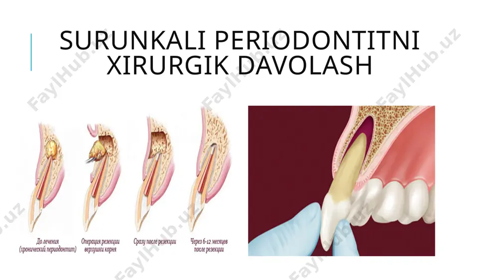 surunkali periodontitlarni konservativ-xirurgik davolash usullari - Page 3