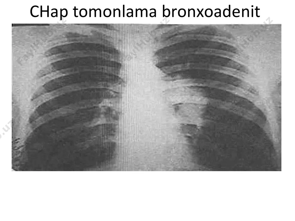 birlamchi tuberkulez - Page 4