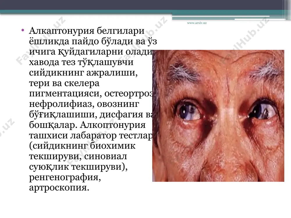 плекслар билан характерланади: гомогентизин ацедурия, охроноз ва артропатия. бу белгилар турли вақтларда пайдо бўлади: сийдикнинг тўқлашиши туғилгандан болади, тўқималар пигментацияси 30 ёшда яққол ифодаланади, бўғимлар зарарланиши хаётнинг 4чи 10 йиллигида пайдо бўлади. www.arxiv.uz алкаптонуриянинг эрта белгиларини эрта болалик даврида билиш мумкин: боланинг хўл чойшабларида сийдикнинг тўқ излари қолади, уларни ювиб хам кетказиб бўлмайди. кейинчалик сийдик айириш азолари томонидан пиелонефрит, сийдик тош касаллиги, калкулёз простатит ривожланиши мумкин. алкаптонурияда тери синдроми юзда(бурин бел оғиз ва кўз атрофи сохаларида) бўйинда, кафтда, коринда, кўлтикда ва чов сохаларида кулранг қўнғир пигментация пайдо бўлиши билан характерланади. www.arxiv.uz вақт ўтиши билан аорта ва юрак клапинлари калцификацияланиши ривожланади ва бунинг натижасида атероскелероз орттирилган аортал ва метрал иллатлар келиб чиқади. алкаптонуриянинг оғир формаларида пигментнинг қалқонсимон безда, буйрак усти безларида, ошқозон ости бези ,талоқда тўпланиши мумкин. алкоптонурияда таянч харакат тизимининг зарарланишини асосан оёқларнинг йирик бўғимлари ва умуртқаларда кўришимиз мумкин. дастлаб деформацияловчи спандилёз типидаги ўзгаришлар бел умуртқаларида ва кейинчалик кўкрак умуртқаларида …