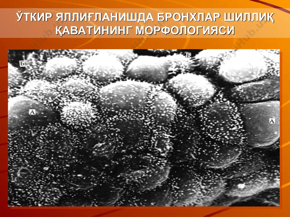 а , афх ўнг ўпка 3 бўлакдан иборат—юқори, ўрта ва пастки, чап ўпка эса — 2 бўлакдан — юқори ва пастки. ўнг ўпканинг ўрта бўлагига чап ўпкада тилчали бўлак тўғри келади. ўпканинг алоҳида бўлакларининг ривожланиши бир текис кечмайди. болаларда ҳаётнинг 1 —йилида чап ўпканинг юқори бўлаги суст ривожланган, ўнг ўпканинг юқори ва ўрта бўлаклари эса деярли бир ҳил ўлчамга эга. фақатгина 2 ёшга бориб ўпканинг алоҳида бўлаклари, катталарники сингари, бир —бирига мос келади. ўпка ўнг ўпкада 10 та сегмент фарқ қилинади, чап ўпкада эса 9 та. юқориги ўнг ва чап бўлаклар 3 та сегментга бўлинади: юқори чўққили-1, юқори opқa-2, юқори олдинги-3. айрим ҳолларда мустақил деб хисобланмайдиган яна бир қўшимча сегмент қўлтиқ ости сегменти фарқланади. ўнг ўрта бўлак 2 та сегментга бўлинади: ўрта —ёнбош сегмент —4 (у орқада жойлашади) ва олдинда жойлашган ўрта — олдинги сегмент — 5. ўпка чап ўпканинг ўрта бўлагига тўғри келувчи тилчали бўлакда ҳам 2 та сегмент …
