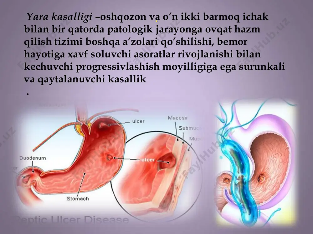 rmoqli ichakda yoki oshqozonda endoskopik tasdiqlangan oshqozon yarasi nuqsonining diagnostik mezonlar me’da osti bezu yarasi bir nechta biopatlarning morfologik tekshiruvi bilan tasdiqlanish kerak diagnostika mezonlari vidi yazv proton nasos ingibitorlari antibakterial dorilat vismut dorilari e’tiboringiz uchun raxmat