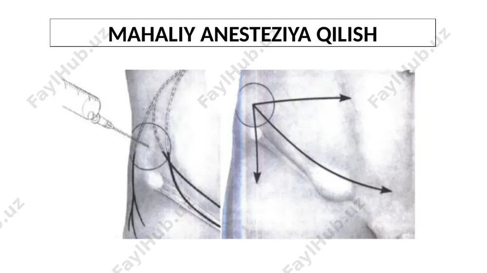 bo‘shlig‘iga kiritishda qiyinchilik yuzaga kelsa, yoki qorin parda bo‘shlig‘idagi patologik jarayonga (churra siqilishi, metastazlar va boshq.) shubha paydo bo‘lsa, churra xaltasini kesib ochish kerak. buning uchun churra xaltasi qisqichlarga olinadi, bo‘ylamasiga kesiladi va kesilgan chetlari to‘rtta qisqichlar bilan yon tomonlarga tortiladi. ichakning fiksatsiyalangan segmetlari, agar ular bitishmalar bilan yopishib ketmagan bo‘lsa, qaychilar bilan ajratiladi. ichak uzun masofada ajratilmasligi lozim, buning o‘rniga churra xaltasi yopilib, kiset chok yordamida tikliish kerak churra xaltasiga qiyin ajraladigan ichak segmentlari yopishgan to‘g‘ri chov churralari va sirpanuvchi churralar tashqi kiset chok yordamida tikiladi. kiset chok puxtalik bilan qo‘yilishi kerak (ichkaridagi tuzilmalarni shikastlab qo‘ymaslik maqsadida). to‘g‘ri chov churrasini ochishga ko‘rsatma yo‘q, odatda bunday churra xaltasi tashqi kiset chok yordamida to‘qimalarga tikiladi. churra xaltasi to‘g‘rilangandan so‘ng chok tortib bog‘lanadi va churra xaltasi fassiya sathidan pastga tushadi. shu ish davomida ko‘ndalang fassiyani kesish va qisqichlar bilan kengaytirish tavsiya etiladi. bu ko‘ndalang fassiyaning ichkariga kirib ketmasligini ta’minlaydigan va keyinchalik plastikada …