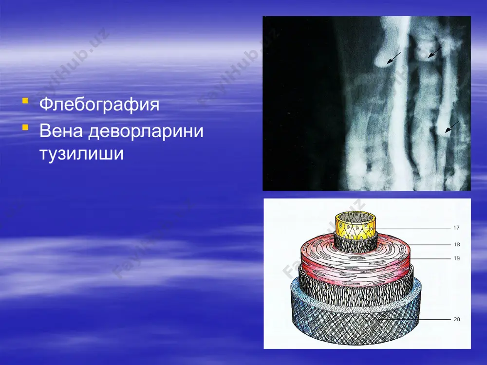 на –v. interventricularis anterior ћамда чап ќиррадаги вена – v. marginalis sinistra ларнинг ќуйилишидан ћосил бўлади; 2) v. ventriculi sinistri – чап ќоринча венаси; 3) v. obliquna atrii sinistri – чап бўлмачанинг ќийшиќ венаси; 4) v. cardiaca media – юракнинг ўрта венаси; 5) v. cardiaca parva – юракнинг кичик венаси. бу венага v.marginalis dextra – ўнг ќирра венаси, ћамда – v. venticuli dextri – ўнг ќоринчани веналари ќуйилади; 6) v.v. cardiaca minimae – юракнинг майда (энг кичик) веналари ўнг бўлмача веналаридан – v.v.atriales dextrae ћамда ўнг ќоринча веналари – v.v. ventriculares dextrae дан ташкил топади. бундан ташќари юракда р. вьессен (1706) ва а. тебезия (1708) томонидан текширилган, юракнинг ќоринчаларига очиладиган ќон томирлар ћам бўлади. ўпка веналари – venae pulmonales. ўпка веналари икки жўфт бўлиб, юракнинг чап бўлмасига ќўйилади. вена номи билан аталса ћам ичида кислародга бой бўлган артериал ќон бўлади. venae pulmоnales ўпка веналари ќуйидаги веналардан ћосил бўлади: 1) venae …