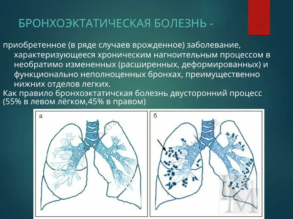 вследствие потери тонуса стенки бронха или её растяжения бронхиальным секретом (например, при муковисцидозе) патогенез. i поражение слизистой(клиники нет) обтурационный ателектаз. снижение активности сурфактанта сдавление податливых, а возможно, и врожденно неполноценных бронхов гиперплазированными прикорневыми лимфатическими узлами длительная закупорка бронхов плотной слизистой пробкой при острых респираторных инфекциях повышение внутрибронхиального давления при кашле растяжение бронхов скапливающимся секретом . ii поражение стенки бронха по всей толщине(повышение температуры, барабанные палочки - форма пальцев, дыхательная недостаточность) расширение бронхов и задержка бронхиального секрета способствуют развитию воспаления. перестройка слизистой оболочки с полной или частичной гибелью мерцательного эпителия и нарушением очистительной функции бронхов; дегенерация хрящевых пластинок, гладкой мышечной ткани с заменой фиброзной тканью и снижением устойчивости, способности выполнять основные функции. хронизация инфекционно – воспалительного процесса. iii стадия гнойных осложнений в лёгких, поражения органов (легочное сердце, амилоидоз почек и т.д.). бронхоэктазия приводит к нарушению механизма откашливания, застою и инфицированию секрета в расширенных бронхах, развитию хронически текущего, периодически обостряющегося нагноительного процесса. …