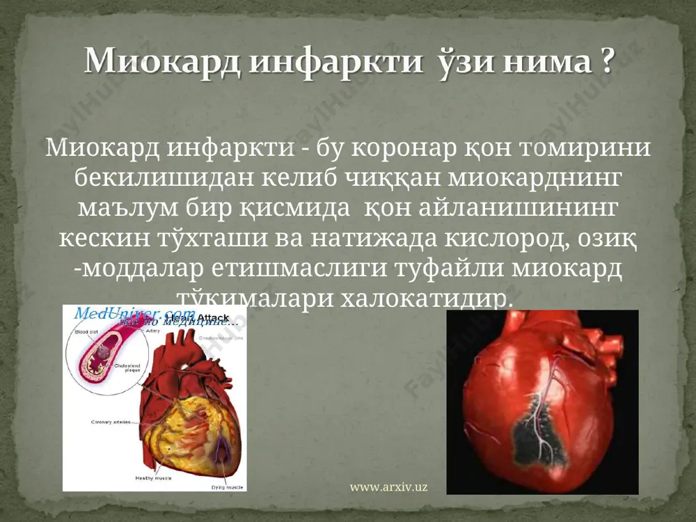 ортманг! вақтида кўрсатилган ёрдам, инфактдан ўлимни келиб чиқишини камида 2-5 баробарга камайтиради, хар бир кечиктирилган ярим соат эса камида бир йилга қисқартиради. www.arxiv.uz www.arxiv.uz стационарга тушгунга қадар: 50-60% беморлар касалхонага ётмасдан вафот этадилар (кеч мурожаат қилишлари хисобига) стационарда энг замонавий воситалар билан даволаниш натижасида - 85 – 95% беморларда тўлақонли ҳаётга қайтаришга имконият бор (беморнинг холатига боғлиқ: йўлдош касалликлар, ёши, такрорий, катта ўчоқли инфарктлар) инфарктдан кейинги 1 йил ичида – беморларнинг 85 - 90% поликлиника шифокорларининг, кардиологлар тавсияси билан олиб борилган кузатуви остида яхшиланадилар www.arxiv.uz www.arxiv.uz * оғриқни қайталаниши (такрорий инфаркт эхтимоли юкори) юрак етишмовчилик белгиларини пайдо бўлиши (хансираш, горизонтал холатни қабул қила олмаслик, шишлар пайдо бўлиши) турли ҳил юрак ритмнинг бузилишлари келиб чиқиши (тўсатдан ўлим холатларига сабабчи) қон босимининг турғун бўлмаслиги (гипертониянинг сақланиб қолиши ёки аксинча мушак етишмовчилиги туфайли ақб нинг пасайиб кетиши 90/60 мм.см.ус.) бунинг натижасида миокард инфарктдан кейин беморнинг ҳаёт сифатини кўрсаткичи камаяди ва хатто ўлимга сабаб …
