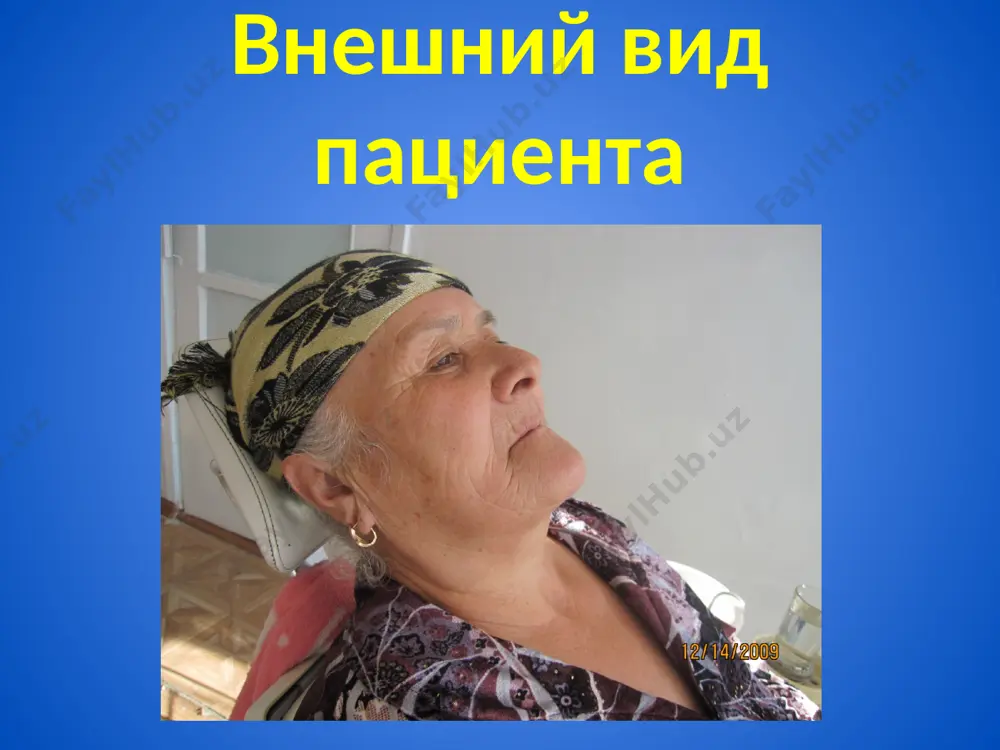 нции (высокий свод неба, выраженные альвеолярный отросток и верхнечелюстные бугры). второй тип наблюдается средняя степень атрофии альвеолярного отростка, альвеолярные бугры еще сохране­ны, небный свод ясно выражен. переходная складка распо­ложена несколько ближе к вершине альвеолярного отрост­ка, чем при первом типе. при резком сокращении мимиче­ских мышц может быть нарушена фиксация протеза. формы небного свода формы небного свода: глубокая, средняя, плоская. третий тип характеризуется резкой ат­рофией: альвеолярные отростки и бугры отсутствуют, небо плоское .переходная складка расположена в одной горизонтальной плоскости с твердым небом. при протезировании этого типа беззубой челюсти создают­ся трудности, поскольку протез приобретает значительную свободу для передних и боковых сдвигов при разжевывании пищи, а низкое прикрепление уздечек и переходной склад­ки способствует сбрасыванию протеза келлер различает четыре типа беззубых нижних челюс­тей типы беззубых челюстей по келлеру: а — первый тип; б — второй тип; в — третий тип; г — четвертый тип. при первом типе альвеолярные отростки не­значительно и равномерно атрофированы. при этом …
