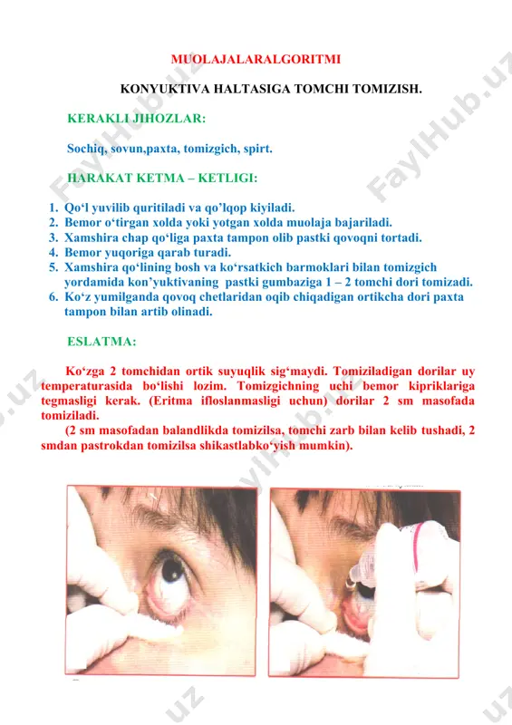 robirkani gorizontal chiziq bo‘yicha o‘z tirkishidagi chakka terisiga taqab qo‘yiladi. 3. zuluk yopishib olmaguncha tik holda ushlab turiladi. 4. keyin probirkaga olib qo‘yiladi. 5. chakkaga ko‘pibilan 2 ta zuluk qo‘yish tavsiya etiladi. 6. 36 – 60 minutn o‘tgach, zuluk o‘zi tushib ketmasa, ustiga gipertonik natriy xlor eritmasi yoki tuz sepish kerak. 7. chakka bir necha kunga qattiq qilib bog‘lab qo‘yiladi. eslatma: zulukni vena yoki arteriya ustiga qo‘yib bo‘lmaydi. chakkaga ko‘pi bilan 2 tazuluk qo‘yish mumkin. muolajalaralgoritmi ko‘z yo‘llarini zondlash. kerakli jihozlar: 0,25 – 0,5% lidikain, paxta, lotok, 5 grshprits, zondlar, 1:5000 furatsillin eritmasi, stul. harakat ketma – ketligi: 1. muolaja stulda o‘tirgan holatda bajariladi. 2. kon’yunktiva 0,25 – 0,5% li dikain eritmasi tomiziladi. 3. pastki ko‘z yosh nuqtasidan ingichka zond bilan kengaytiriladi. 4. zondning pastki ko‘z yosh nuqtasidan oldin vertikal, so‘ngra gorizontal yo‘nalishida burun suyagiga qadab yotqiziladi. 5. ko‘z yosh xaltasi va ko‘z yosh burun yo‘li orqali zond burunga kiritiladi. …