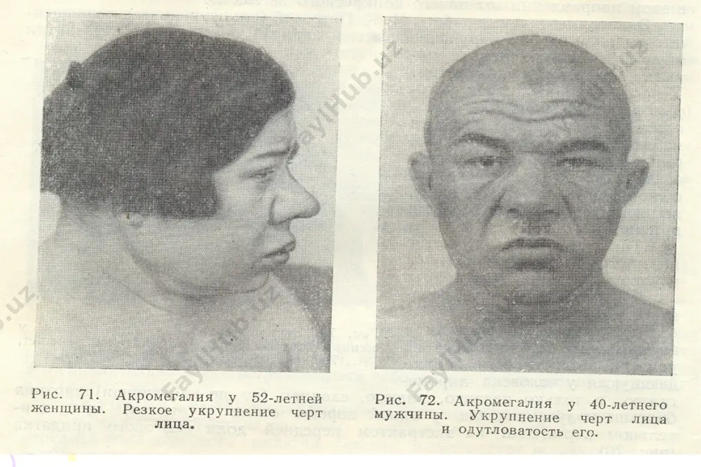 акромегалия - Page 3