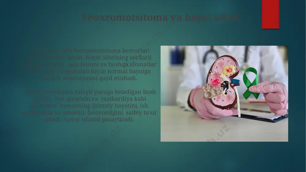 ni nazorat qilish uchun zarurdir. feoxromotsitomaning sabablari taxminan 80-90% hollarda feoxromotsitomaning aniq sababi noma'lum bo'lib qoladi, bu esa idiopatik feoxromotsitoma deb ataladi va diagnostika qiyinlashtiradi. ba'zi hollarda, feoxromotsitoma rivojlanishiga gormon ishlab chiqaruvchi hujayralarning o'sishini rag'batlantiruvchi onkologik jarayonlar, shuningdek, spontan mutatsiyalar sabab bo'lishi mumkin. feoxromotsitomaning alomatlari feoxromotsitoma belgilari ko'pincha paroksismal yoki doimiy yuqori qon bosimi bilan, taxminan 75% hollarda kuzatiladi, shuningdek, taxikardiya va bosh aylanishi bilan ham namoyon bo'ladi. taxminan 10% hollarda feoxromotsitoma nafas qisilishi, ko'krak og'rig'i va diareya kabi oshqozon-ichak trakti simptomlari bilan birga kechadi, bu esa katekolaminlar ta'siriga bog'liq. jarrohlik amaliyoti jarrohlik amaliyoti, o'smaning kattaligiga va joylashuviga qarab, laparoskopik yoki ochiq jarrohlik yo'li bilan 90% dan ortiq muvaffaqiyat darajasiga erishishi mumkin. pheoxromotsitoma olib tashlash jarrohligi taxminan 2-4 soat davom etadi va bemorning yoshi, umumiy holati va o'smaning murakkabligiga bog'liq. e'tiboringiz uchun rahmat @taqdimot_robot image6.jpg image7.jpg image8.jpg image9.jpg image10.jpg image11.jpg image12.jpg image13.jpg image14.jpg image15.jpg image16.jpg image17.jpg image2.png image3.png image4.png image5.png