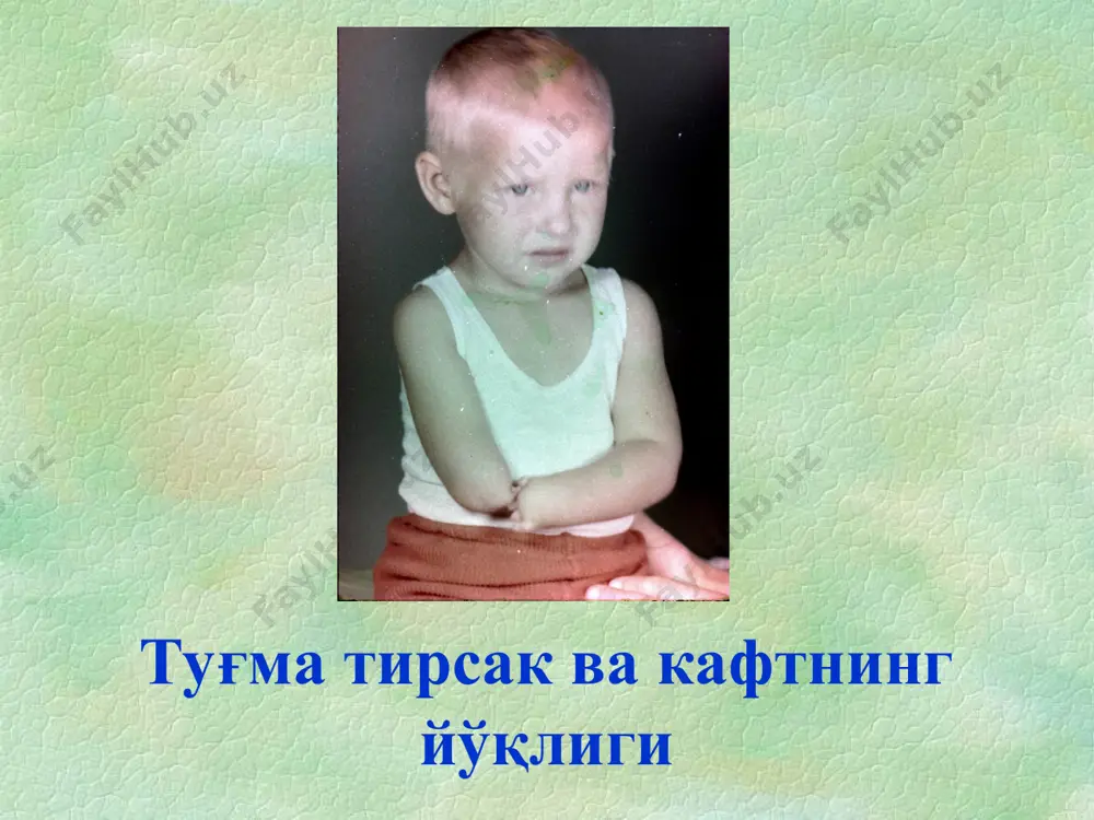 кам учрайди, даволаш жуда қийин маймоқоёқлик компонентлари 1. болдир ҳажми кичрайиши: уч бошли, катта болдир, бармоқларни букувчи мушаклар қисқарган ва ҳажми кичрайган. маймоқоёқлик компонентлари 2. эквинусли товон жойлашуви (фиксацияланган товон бўғимидаги букилиш, товон суягининг юқори жойлашуви ва ошиқ суяги товонда букилган холатда. маймоқоёқлик компонентлари 3. варусли оғиш маймоқоёқлик компонентлари маймоқоёқлик компонентлари 5. кавус (оёқ бўйлама камарининг ортиши, олдинги бўлим ўртасига нисбатан пронацияда, ўрта бўлим эса олдингисига нисбатан супинация холатида. маймоқоёқлик компонентлари 6. биринчи метатарсал суяк нисбатан кучли ифодаланган букилиш холатида бўлади. маймоқоёқлик компонентлари 7. маймоқоёқлик бор оёқ одатда соғига нисбатан кичикроқ бўлади. маймоқоёқликнинг бошқа симптомлари оёқнинг супинация холати шу қадар кучли ифодаланган бўлиши мумкинки, товон болдирнинг ички томонига тегади, қадоқлар пайдо бўлади. маймоқоёқликнинг бошқа симптомлари товоннинг кўндаланг буришиши (инфлексия), кўндаланг бурма хосил қилиб, товон ўрта бўлими ички қирғоғи бўйлаб йўналади. (адамс бурмалари); маймоқоёқликнинг бошқа симптомлари болдир суякларининг ташқарига буралиши (торсия); товон бармоқлари варусли деформацияси; тизза бўғимлари иккиламчи вальгусли деформацияси маймоқоёқликнинг …