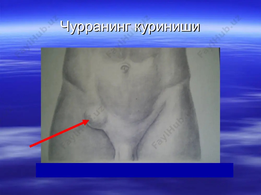 н сетка кулланилиши полипропилен сетка кулланилиши полипропилен сетка кулланилиши полипропилен сетка кулланилиши полипропилен сетка кулланилиши полипропилен сетка кулланилиши чакалоклардаги киндик чурраси чакалоклардаги киндик чурраси олдини олиш: кукрак ёшидаги болаларни тугри парвариш килиш; жисмоний тарбия ва спорт билан мунтазам шугулланиш; семизлик ва айникса, ундан кейинги озишдан сакланиш; ташкилотларда ходимларнинг жисмоний кучи ва соглигига караб иш билан таъминлаш; чурра билан огрийдиган шахсларни оммавий куриклар натижасида топиб, уларни уз вактида, режали равишда оператив даволаш.