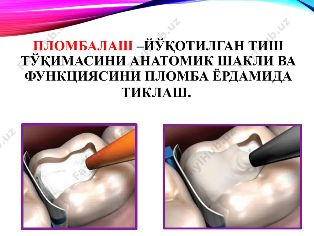 ди. яллиғланишга қарши моддалар қўшимча моддалар антимикроб моддалар ферментлар комбинирланган даволовчи тагликлар таркиби: одонтотроп воситалар – кальций гидроксид, фторидлар, кальций глицерофосфат, гидроксиаппатитлар ва б. яллиғланишга қарши воситалар – глюкокортикоидлар, ностероид воситалар. антимикроб воситалар – хлоргексидин, метронидазол, лизоцим, натрий гипохлорид, этоний малҳами. протеолитик ферментлар – профезим, стоматозим, имозимаза ва б. pulpomixine малхами – дексаметазон ва антибиотиклар (фрамицетин ва полимиксин) таркибли. дексаметазон – яллиғланишга қарши, пульпадаги шиш, томирларнинг эзилиши ва ишемиясини тез бартараф этади. антибиотиклар – патоген микроорганизмларга қарши курашади. 1-3 кунга қўйилади. даволовчи тагликларни қўйиш схемаси ажратувчи тагликлар – талаблар: пульпани турли таъсирлардан химоялаш ва зарарли таъсир этмаслик; чархлаш ва пломбалашдан кейин пайдо бўлувчи сезгирликни олдини олиш; дентинга реминерализацияловчи таъсир этиши; чайнов босимига чидамли бўлиши керак. доимий пломба фиксациясини ошириш ва унинг хусусиятларини ўзгартирмаслик; турли суюқликлар таъсирида ўзгармаслиги лозим; бўшлиққа осон кириши, тез қотиши ва тиш тўқималари билан мустахкам боғланиш хосил қилиши. ажратувчи тагликлар: асосли таглик юпқа қаватли таглик (лайнер) асосли …
