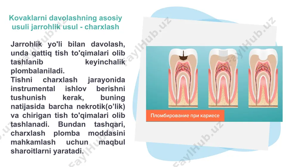 tniy polutora-dvuxchasovoy effekt. optimalniy variant dlya prodoljitelnix manipulyatsiy – slojnogo udaleniya zubov, endodonticheskogo lecheniya, ustanovki implantov, udalenii kist, kyuretaja i loskutnix operatsiy na desnax. infiltratsionniy metod ispolzuetsya v stomatologicheskoy praktike i chelyustno-litsevoy xirurgii. preimushestvom metoda yavlyaetsya bistroe deystvie, dlitelniy obezbolivayushiy effekt, vozmojnost povtornogo vvedeniya pri zatyanuvsheysya operatsii, bistroe vivedenie anestetika iz organizma, glubokoe analgizirovanie bolshoy ploshadi tkaney. poryadka vosmidesyati protsentov stomatologicheskix vmeshatelstv provodyatsya pod infiltratsionnoy anesteziey. anesteziruyushee lekarstvo vvoditsya posloyno, snachala pod slizistuyu u verxushki zubnogo kornya, a posle – v bolee glubokie sloi. patsient chuvstvuet diskomfort tolko pri pervom ukole, ostalnie provodyatsya absolyutno bezboleznenno. dlya mestnoy infiltratsionnoy anestezii v stomatologii ispolzuyutsya takie preparati: prokain. lidokain. mepivakain. ultrakain trimekain. artikain septonest intraligamentarniy (vnutrisvyazochniy) metod yavlyaetsya sovremennoy raznovidnostyu infiltratsionnogo obezbolivaniya. doza vvodimogo anestetika minimalna (ne previshaet 0,06 ml), chto delaet vozmojnim lechenie i udalenie zubov u beremennix i kormyashix jenshin. anestetik vvoditsya v periodontalnoe prostranstvo s pomoshyu spetsialnogo shpritsa i pod …