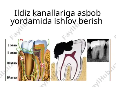 ildiz kanallariga asbob yordamida ishlov berish — PPTX