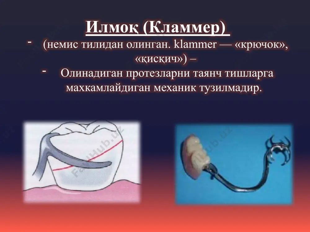 ион элементлари: окклюзион накладка; тана; елка; дум. илмоқ елкасига қўйилган талаблар: елка тиш ларниг вестибуляр ёки орал юзаси бўйин қисмига яқин жойлашиши керак 2. елка тиш юзасига максимал тегиб туриши керак 3. елка протезни қўйиш вақтида активлашиши керак ( пружинасимон ҳаракат) 4. елка тишга босим бермаслиги керак ва харакатлар вақтида протезни махкам ушлаши керак 5. елка охирги чети думалоқ ва ўтмас бўлиши керак, лаб ва лунж шиллиқ қаватини жарохатламаслик учун. елка окклюзион накладга қўйилган талаблар: 1. у чайнов юзанинг табиий фиссуралар ва чуқурчаларда жойлашиши керак 2. у табиий тишга вертикал босимни ўтказиши керак 3. у антогонистлар орасидаги контактни тиклаши керак 5. у функциялар даврида протезни фиксация ва стабилизациясини таъминлаши керак. окклюзион накладка (он) кламмер танасига қўйилган талаблар: 1. таянч тишларнинг апроксимал юзасида жойлашиши керак 2. кламмернинг конструктив қисмларини бирлаштиради 3. тана хам чайнов босимини ўтказишда қатнашади. тана илмоқ думига қўйилган талаблар: илмоқ думи протез базиси хом-ашёсига илмоқни махкамлаб туради илмоқ …