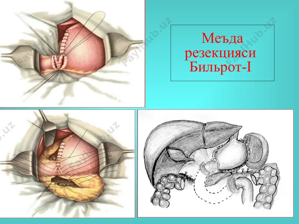 postgastrorezektsion sindromlar - Page 3