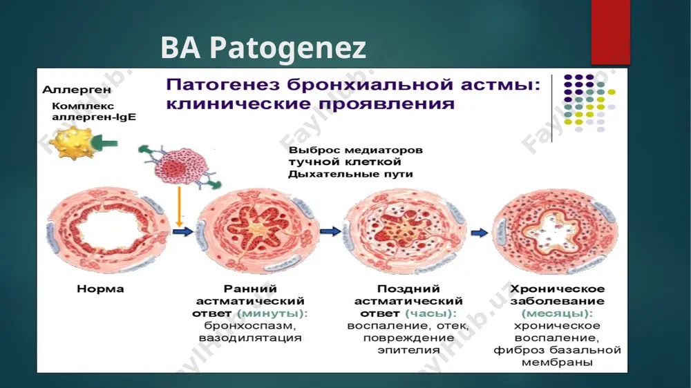 n prognoz qilinganidan 60-80%. nchon tebranishlari > 30%. og’ir persistirlanuvchi ba kun davomida tez-tez uchraydigan alomatlar . tez- tez kasallikning avj olishi va tungi simptomlar . jismoniy faollik cheklangan . fnchh yoki nchon 30%. ba huruji ba kontrol qilish darajalari terapevt praktikasida diagnostika qilish qiyin bo’lgan ba turlari bolalikda astma . qariyalarda astma . kasbiy astma . mavsumiy astma . astmaning yo'tal varianti ba va o’pkaning surunkali obstruktiv kasalligi differensial diagnostikasi . da’vodan ko’zlangan maqsad : surunkali alomatlar , shu jumladan tungi simptomlarning minimal darajada namoyon bo’lishi yoki umuman bo’lmasligi ; minimal ( kamdan-kam ) avj olish jarayonining bo’lishi ; shoshilinch yordamni talab qiladigan shartlarning yo'qligi ; beta-2 agonistlariga minimal (ideal holda ) ehtiyoj ; jismoniy faoliyatga , shu jumladan sportga cheklovlar yo’q ; nchon ko'rsatkichlarining kun davomida tarqalishi 20% dan kam ; normal yoki normal nchon qiymatlariga yaqin ; minimal namoyon bo'lishi yoki dori vositalaridan nojo'ya ta'sirlarning yo'qligi ; …