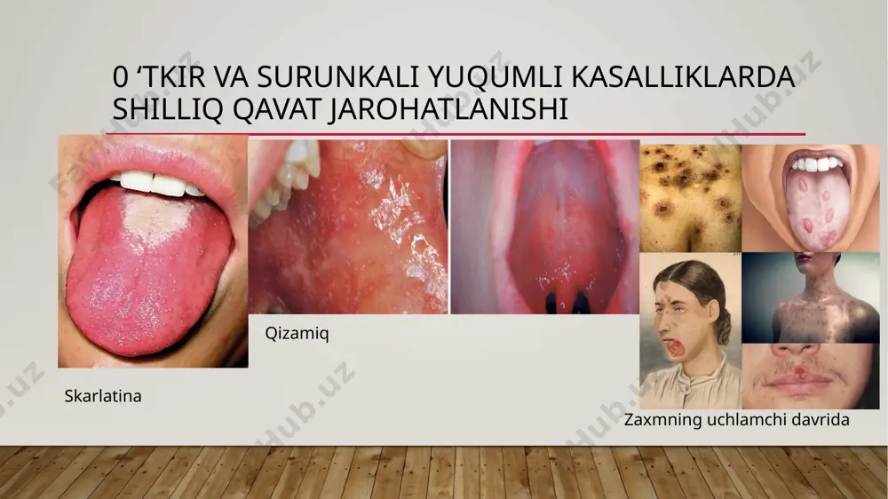 lik. ikki xil turi farqlanadi: quruq va eksudativ. quruq formasida bemorlar lablari qurib qolishiga, ayrim hollarda achishishi, qichishishiga shikoyat qiladilar. lab shilliq pardasini og‘iz shilliq pardasiga o‘tish joyida giperemiyalangan chiziq bo‘lib, uning usti qatqaloq bilan qoplangan, qatqaloqlar olinganda to‘q-qizil rangli yuza, ayrim hollarda yuza eroziyalar hosil bo‘ladi. quruq shakl eksudativga aylanishi mumkin. eksudativ formasida lablar kattalashgan, qizargan, shishgan bo‘ladi. lablar tutashtirilganda og‘riq paydo bo‘lganligi uchun og‘iz yarim ochiq labda qatqaloq, po‘stloq bilan qoplangan. til kasalliklari deskvomativ glasit tilning o‘z shilliq qobiq qavatidagi distrofik yallig‘lanish kasalligidir. kasallik epitelial shoxlanish buzilishi va til so‘rg‘ichlarining distrofik o‘zgarishi bilan kechadi. kasallik subyektiv o ‘zgarishlarsiz kechadi. ayrim hollarda bemorlar tilidagi siqilish achishishidan shikoyat qiladi. bemorlaming og‘iz bo‘shlig‘i sanatsiya qilinib, antiseptik eritmalar bilan chayiladi va keratoplastik vositalar qo‘llanadi. rombsimon glasit surunkali kasallik bo‘lib, til orqasidan uchinchi qismning o‘rta chizig‘i bo‘ylab, oldingi bo‘g‘inga so‘rg‘ichli yo‘nalishda shilliq parda qavatining qotishidir. kattaligi 0,5 dan 2,5 sm gacha kuzatiladi. rombsimon …