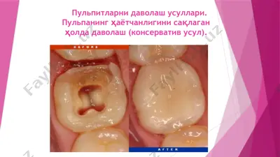 пульпитларни даволаш усуллари — PPTX