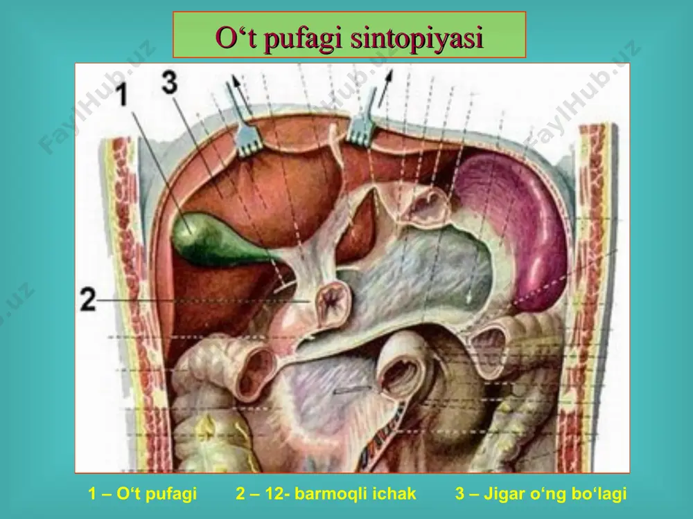 ruvlarda topiladi. 3. yaqqol namoyon bo‘lgan klinik manzara. o‘tkir xolesistit, xoledoxolitiaz, fater so‘rg‘ichi stenozi, mexanik sariqlik, o‘tkir xolangit, o‘tkir pankreatit va boshqalar rivojlanishi. хасталикнинг субъектив белгилари: o‘ng qovurg‘a ravog‘i ostidagi og‘riq, ko‘ngil aynishi, og‘izda achchiq ta'm sezgisi, jig‘ildon kaynashi, zarda bo‘lish, qayt qilish (qusish), og‘riqlarni ovqatlanishga bog‘liqligi, qorinning dam bo‘lishi, og‘riqning o‘ng kurakka, belga berishi (irradiasiya). o‘t xastaligida og‘riq lokalizasiyasi o‘t xastali o‘ng qovurg‘a ravog‘i ostida, epigastral sohada gida og‘riq lokalizasiyasi xuruj davri muolajasi: yallig‘lanish jarayonini bartaraf etish, spazmolitiklar, infuzion va detoksikasion muolaja, o‘tni haydovchi muolaja, og‘riqsizlantirish (aniq tashxis qo‘yilgach) suv va elektrolitlar muvozanatini tiklash ochlik va qat'iy parhez qilish, dinamik kuzatuvni tashkil etish. diagnostika usullari duodenal zondlash, ul'tratovushli tekshiruv (uzi), kontrast rentgenografiya (xolesisto-, xolangiografiya), komp'yuter tomografiya (kt), laparoskopiya, yader-magnitli rezonans tomografiya (yamr), o‘t pufagining normal manzarasi (uzi) 1. o‘t qopi bo‘shlig‘i 2. o‘t qopi devori 3. o‘t qopi yo‘li 4. jigar to‘qimasi o‘t pufagidagi toshlar (uzi) xolesistografiya 1. o‘t …