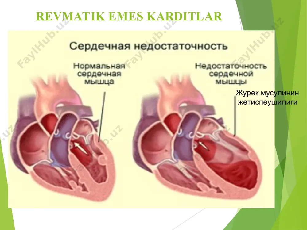 ı mexanizmge iye emes. patogenez xronik karditda revmatik emes kardittiń qozǵatıwshısı tiykarǵı roldi oynaydı. bul processte tiykarınan autoimmun buzılıw áhmiyetli boladı. bunda autodánesheler (antikardial) hám sensiblizaciya bolǵan limfocitler menen autoantigenler qosılıp antikardial antidánesheler payda boladı. bunday jaǵdaydıń sebebi t – supressorlardıń kemeyiwine hám bul t – xelper tásiriniń aktivlesiwi hámde v – limfocitlar giperstimulyaciyasına alıp keledi. klassifikaciyası 1. keselliktiń kelip shıǵıw dáwirine qarap: - tuwma: erte, keshki - arttırılǵan 2. etiologik faktorlar boyınsha: - viruslı - bakteriyalı - virus-bakteriyalı - parazitli - zamarıqlı - iersiniozlı - allergik - idiopatik klassifikaciyası 3. forması boyınsha (processtiń qay jerde jaylasıwına qarap): - kardit - júrek ótkiziwshi sistemasınıń zárerleniwi 4. keshiwine qarap - ótkir – 3 ayǵa shekem - ótkir astı – 18 ayǵa shekem - xronik – 18 aydan kóp (recidivleniwshi, birlemshi xronik: dimlengen, gipertrofik, destriktiv variantları.) klassifikaciyası 5. awırlıǵı boyınsha: - jeńil - orta awır - awır 6. júrek jetispewshiliginiń forması hám …