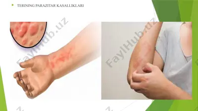 qo’tir (lot.scabies, rus.chesotka, чесотка) — PPTX