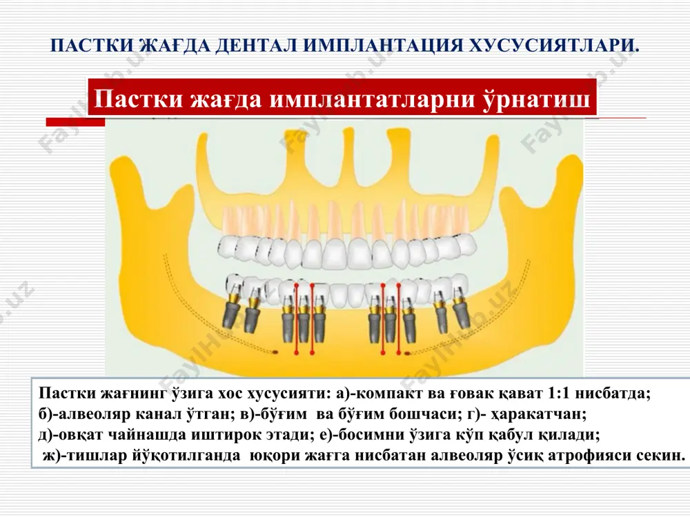 ешиклар, ёриқлар бўлишига; имплантат юзасига титан ёки гидрооксиаппатит билан чанглатишга; имплантат бўйин қисмини силлиқланишига (полировка); оғиз бўшлиғини гигиенасига; - умумий организм холатига боғлиқ. беморларни текшириш усуллари қонни умумий таҳлили қондаги қанд миқдорини аниқлаш коагулограмма сийдик умуий таҳлили ортопантомограмма дентал рентген юсупов буйича рентген рентген компьютер томография магнит-резонанс томография лаборатор текшириш нур диагностикаси стоматологик анамнез юз-жағ сохаси ташқи кўриги оғиз бўшлиғини кўздан кечириш жағларни диагностик моделларини ўрганиш. клиник текширувлар альвеоляр усикни холатини урганиш. шиллик кават ва альвеоляр усик калинлигини улчаш асбоблари шиллиқ ости суяк пардаси ости дентал имплантацига кўрсатма ва қарши қўрсатмалар дентал имплантацига кўрсатмалар битта олд (фронтал) ёки чайнов тишлар бўлмаганда. тиш қаторини чегараланган нуқсонларида (3та ва ундан ортиқ тишларни йўқлиги) тиш қаторини чегараланмаган нуқсонлари. тишларни умуман йўқлиги. беморларда акрилатларга юқори сезувчанлик ва қайт қилиш рефлекси ривожланганлиги сабабли олинадиган протезлардан фойдалана олмаслик. функционал окклюзия йўқлиги сабабли чпжб дисфункция оғриқли синдромини мавжудлиги. абсолют қарши кўратма: қон ва қон хосил қилувчи органлар …