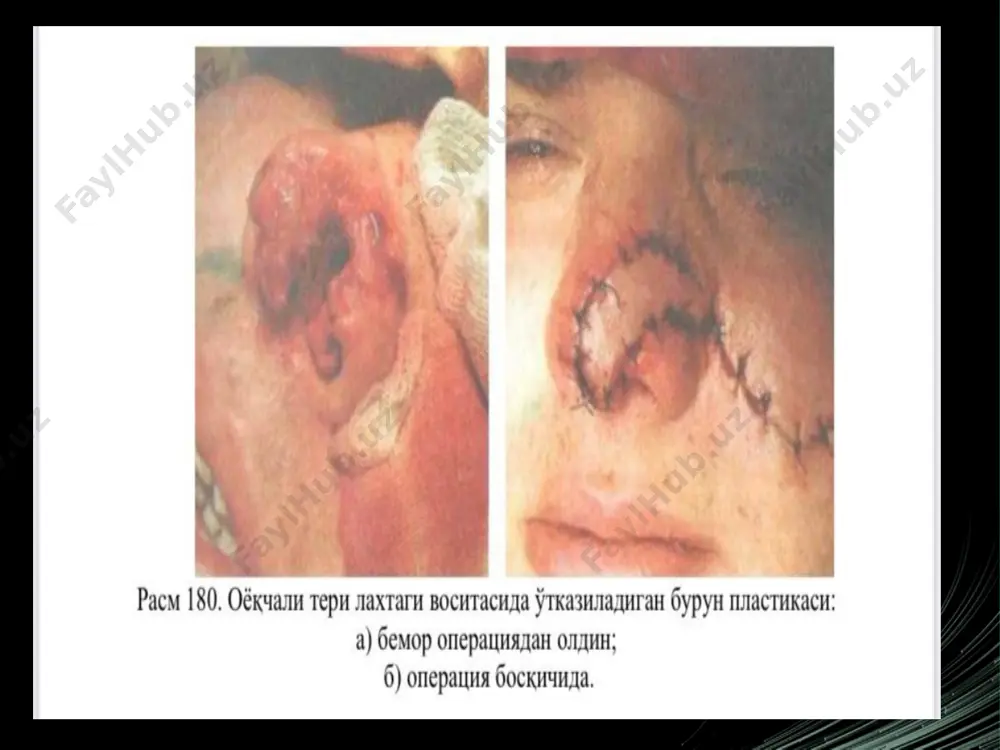 oyoqchali lahtaklar bilan plastika va endoekspander bilan plastika - Page 4
