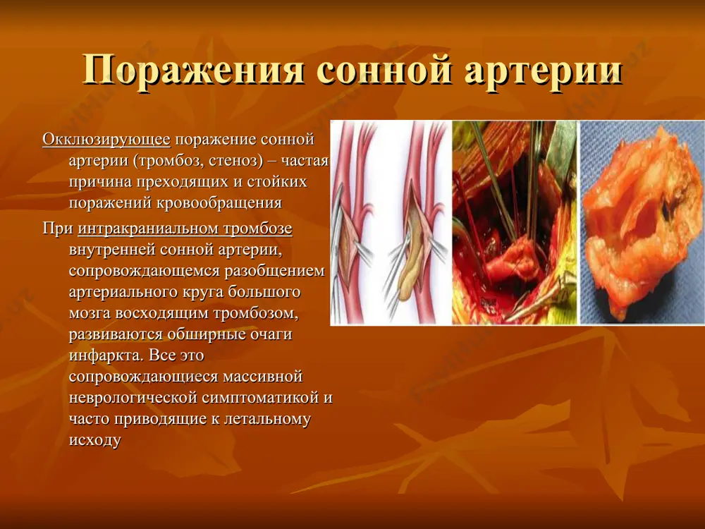 кровоснабжение головного мозга - Page 5