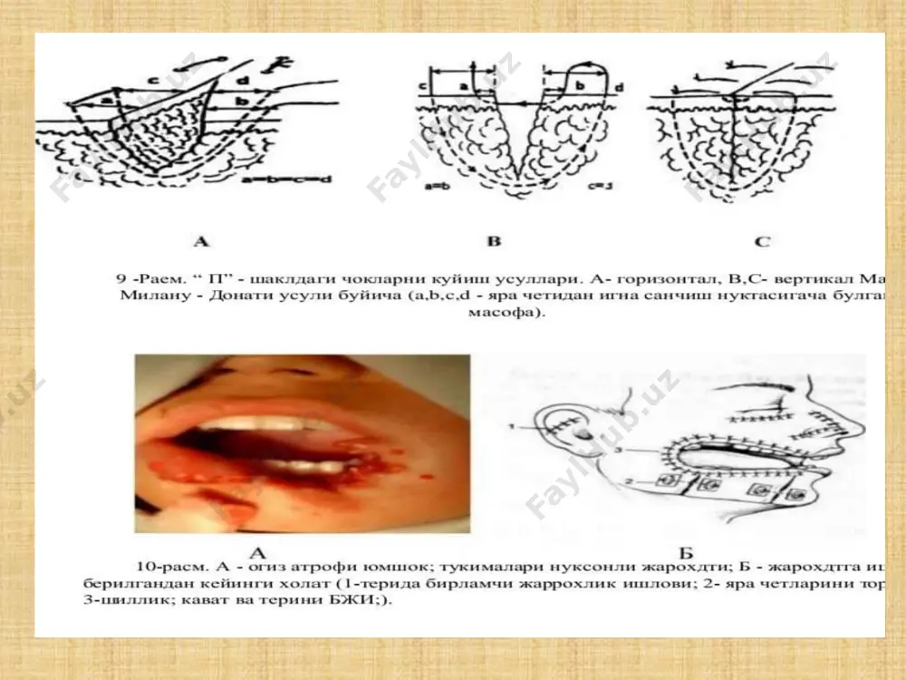, oldingi tishlar bilan taomni uzib ololmasligiga tishlar va milk sezuvchanligining buzilishiga, tishlarning notugri jipslanishi, kalkumda yot jism bordek tuyulishi, shuningdek, kungil aynishi, burundan nafas olishning kiyinlashganligidan shikoyat kiladi. yukori jagning urta tipda (lefor ii) suborbital sinishi sinish chizigi yukori jagning peshona usigi, peshona suyagining burun kismi va burun suyaklarini choki dan, utib kuz kosasining medial devorini tashkil kilgan kuz yoshi suyagi, galvirsimon suyakning kuz tomondagi plastinkasi va ponasimon suyak tanasining lateral yuzasidan pastga-pastki kuz yorugiga utib va yukori jag va yonok suyaklari (tanglay suyagining kuz usigidan iborat orbitaning pastki devoridan oldinga yunalib) kuz kosasining pastki cheti va yonok-jag chokidan yoki yonidan utadi. shikoyatlar: pastki tipdagi sinishga monand bulib, yukorida kursatilganidan tashkari: kuz osti soxasi, yukori lab, burun kanoti, burun tusigining tern kismi uvishishi, shuningdek, burun-kuz yoshi yuli shikastlanganda yosh okishiga, katta ozik tishlar va milkda kattik va yumshok tanglay tukimalarida sezuvchanlik sakdanib koladi. yukori tipdagi subbazal sinish (lefor i) …