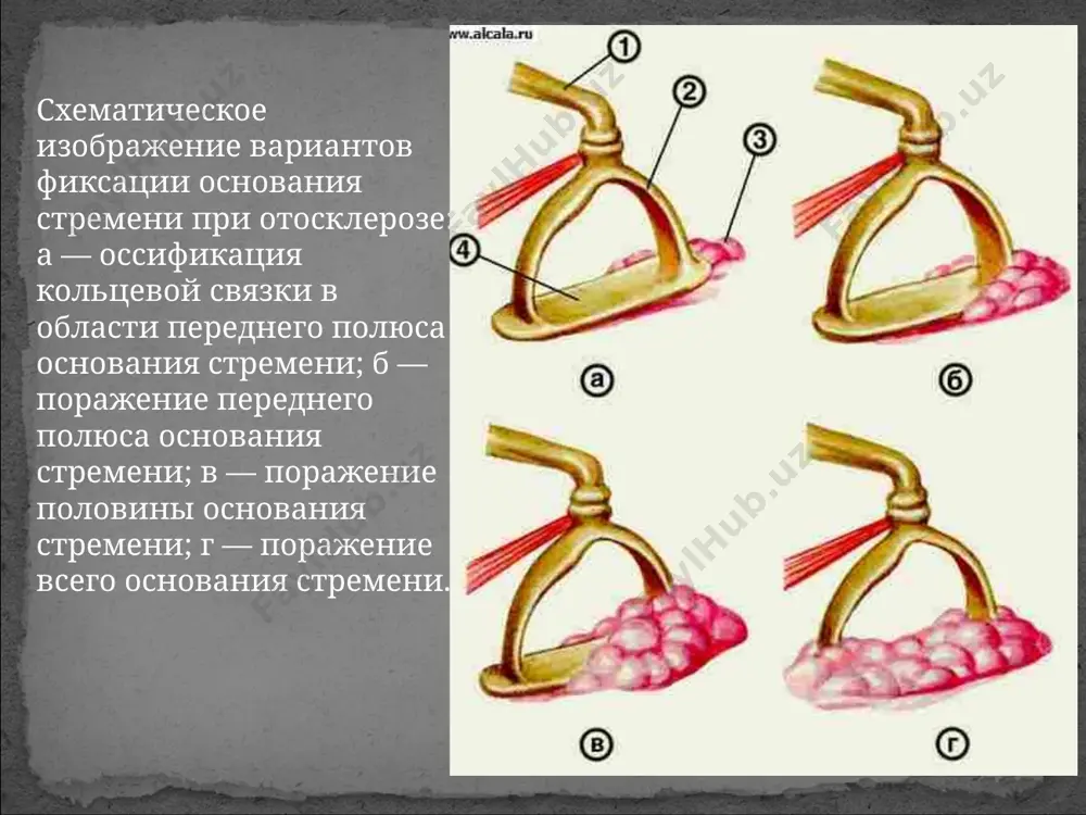 отосклероз - Page 4