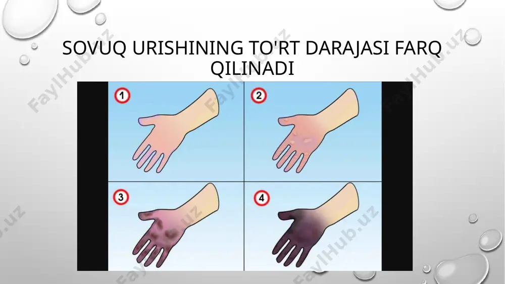 tez va kuchli chiqishi terining epidermis qavatini ko'tarib, qizg'im tir-seroz suyuqligi bo'lgan pufakchalar hosil qiladi. ko'kqizil teri sathi og'riydi, shishadi. iii-darajali sovuq urishda terining chuqur qavatlari va teri osti yog' qavati zararlanadi. o 'lgan to'qim alarda qaytarib bo'lm aydigan o'zgarish ro'yobga kelib, ko'kimtir tus oladi. k o'pincha tomirlar trombozi bo'ladi, m a’lum vaqt o'tgach demarkatsion chiziqqa ega bo'lgan total nekroz kuzatiladi. agar unga infeksiya tushsa, h o ‘l gangrena boshlanadi. iv darajali sovuq urishda terining chuqur qavatlari, hatto suyaklar ham nekrozga uchraydi. 4-6 kun o'tgach aniq o 'lg an to'qim alar belgilanadi, nekroz chuqurlasha boradi. 7-10 kun davom ida bemor harorati ko'tarilib, yuqori leykotsitoz, siydikda oqsil aniqlanadi. 1,5-2 oy orasida o'lgan to'qimalar o'z-o'zidan ko'chib amputatsi. yaga uchrashi mumkin, harorat subfebril bo'ladi. sovuq urgan oyoq va qo‘llarning panjalari 4 haftalar ichida, tovon esa 1-2 oy orasida uzilib tushadi. sovuq urishda to'qimalar o'lishining asosiy sabablaridan biri qon aylanishining buzilishi bo'lib, distal tomirlar …