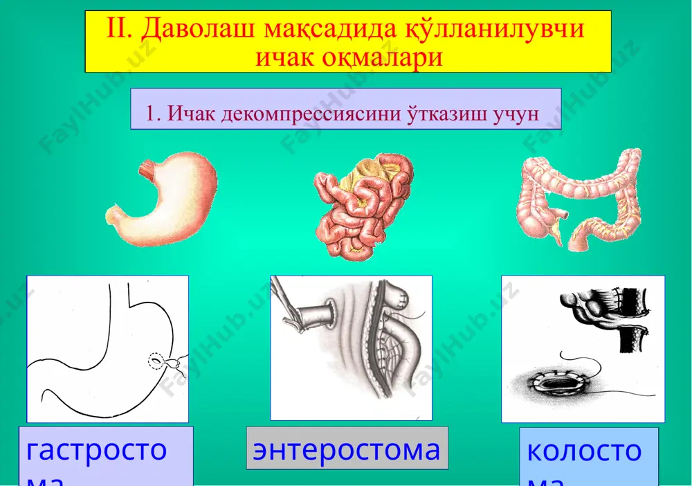 нокислоталар, қон, плазма, витаминлар ва бошқалар, парентерал озуқалантириш (селемин, селепид), энтерал зондли озуқалантириш. 2. организмдаги ичак оқмаси орқали йўқотилаётган керакли моддаларнинг ўрнини ўз вақтида қоплаб бориш ва модда алмашинувининг бузилишига йўл қўймаслик ичак оқмаси қанча юқори жойлашган бўлса – йўқотиш шунча кўп миқдорда бўлади. даволаш тактикаси таъсир доираси кенг антибиотиклар, сульфанила-мид препаратларини қўллаш, қувватни оширувчи препаратларни қўллаш, иммунотерапия, оқмада ширанинг йиғилиб қолишини олдини олиш жароҳат атрофини яллиғланиб кетишидан асраш (лассар пастаси ва б.), вақти келганда жарроҳлик амалиётини ўтказиб, ичак оқмасини йўқотиш (бартараф этиш). 3. антибактериал ва яллиғланишга қарши муолажа ва жарроҳлик амалиётини ўтказиш оқмадан шира йўқотишнинг олдини олиш ва уни организмга қайтариш йўллари оқмадан шира йўқотишнинг олдини олиш ва уни организмга қайтариш йўллари оқмадан шира йўқотишнинг олдини олиш ва уни организмга қайтариш йўллари бартараф этиш усуллари ингичка ичакни оқма билан резекция қилиш ва ээа қўйиш бартараф этиш усуллари йўғон ичакни оқма билан резекция қилиш ва ээа қўйиш бартараф этиш усуллари …