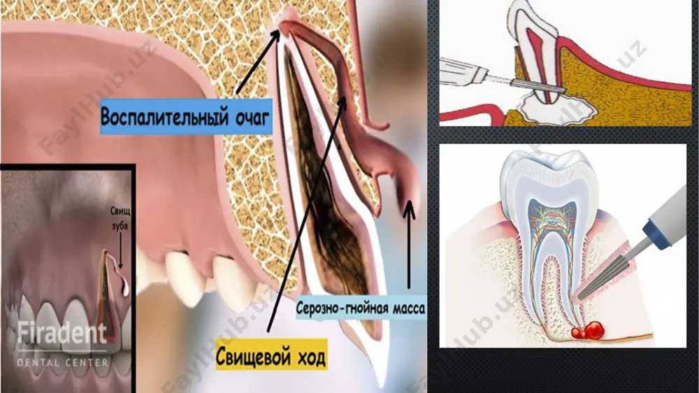 surunkali periodontitni konservativ-xirurgik davolash usullari - Page 4