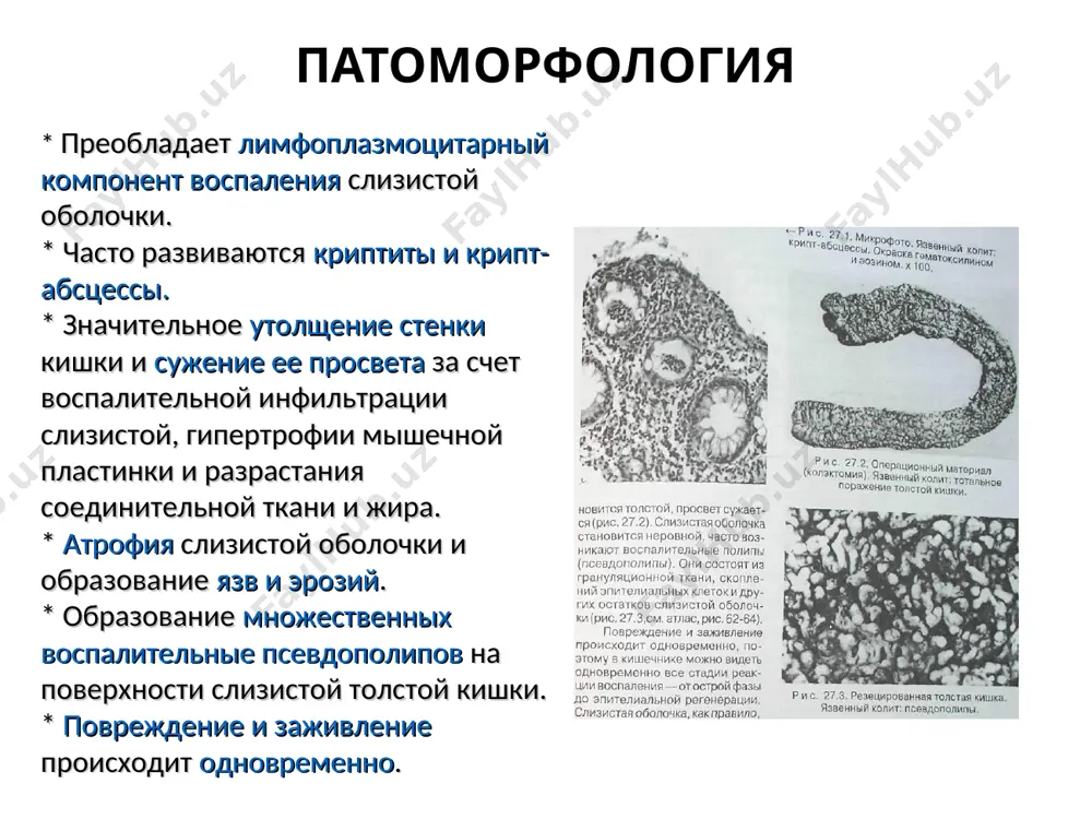 s biopsiey (kolonoskopiya+ ileoskopiya) sigmoskopiya ili rrs (povtorno dlya otsenki dinamiki) gistologicheskoe issledovanie bioptatov isklyuchenie kishech. infektsiy, glistnix invaziy, parazitozov uzi bryushnoy polosti obzornaya rentgenografiya bryushnoy polosti (pri tyajeloy atake) diagnoz d.b. podtverjden endoskopicheski i morfologicheski dopolnitelnie (pri pokazaniyax) irrigoskopiya (pri nevozmojnosti provesti kolonoskopiyu) uzi s rektalnim datchikom, endouzi pri neobxodimosti diff. d-ki (bk, rak, limfoma) rentgenokontrastnoe iss-ie tonkoy kishki s barievoy vzvesyu mrt, kt bryushnoy polosti s kontrastirovaniem kishechnika kapsulnaya endoskopiya balonnaya enteroskopiya fgds rentgenologicheskaya diagnostika nyak rentgenologicheskiy metod ustupaet endoskopicheskomu. ispolzuetsya pri nevozmojnosti provedeniya endoskopicheskogo issledovaniya. dlya diagnostiki oslojneniy nyak ispolzuetsya obzornaya rentgenoskopiya organov bryushnoy polosti, v ostalnix sluchayax - irrigoskopiya (protivopokazana pri tyajelom obostrenii-risk perforatsii i toksicheskogo megakolona). rentgenologicheskie priznaki nyak: * otsutstvie ili umenshenie gaustr; * nerovnost, zazubrennost relefa kishki za schet iz'yazvleniy (depo bariya), oteka slizistoy i nalichiya na ee poverxnosti psevdopolipov (defekti napolneniya); * ravnomernoe sujenie prosveta kishki, ee ukorochenie, sglajennost konturov vplot do …