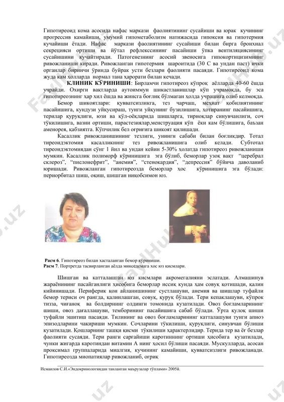 тўпланади. бир вақтда нуклеин кислоталар (днк, рнк), миқдори камаяди, қоннинг оқсилли фракцияси глобулинлар кўпайиши томонга ўзгаради, интерстицияда эса альбуминлар қонцентрацияланади, гемоглобин структураси ўзгаради. оқсиллар учун мембрана ва транскапиллар ўтказувчанлигининг ортиши механизми тўлиқ ўрганилмаган. бу жараёнда вазоактив субстанция (масалан гистаминнинг) иштироки бор деб тахмин қилинади, аммо лимфанинг димланиши натижасида оқсилларнинг қон томирига кайтишининг қийинлашувига боғлаш тўғрироқдир. юракда, ўпкада, буйракларда, сероз бўшлиқларда ва биринчи ўринда терининг ҳамма қаватида нордон гликозаминогликанлар (гаг), кўпроқ глюкурон кислотаси ва озрок миқдорда – хондроитин олтингугурт кислотаси ортиқча тўпланади. қон фибробластларидаги гаг миқдори кескин ортади. гаг миқдорларининг ортиқчалиги бириктирувчи тўқиманинг коллоид структурасини ўзгартиради, унинг гидрофиллигини ва натрийни боғлашини кучайтиради ва лимфостаз шароитида микседемани шакллантиради. туқималарда натрий ва сувнинг ушланишига гипертиреоз ҳолатида вазопрессининг ортиқча ишлаб чиқарилиши шунингдек юрак бўлмачалари натрийуретик омилнинг камайиши ҳам сабаб бўлади. хужайра билан бирга гипонатремияга ва хужайра ичидаги калий қонцентрациясининг камайишига мойиллик бўлади. тўқималарнинг кальцийнинг эркин ионлари билан тўйиниши ҳам камаяди. липолиз маҳсулотларининг утилизацияси ва …