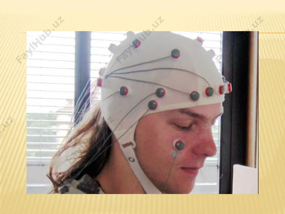 a karab, ushbu arteriyalar o’ tkazuvchanligi o’ zgarganligi aniklanadi.  usul yuqori samaradorligi, bosh va bo’ yindagi magistral tomirlar okklyuziv zararlanish diagnostikasida, stenoz darajasi, kollateral qon aylanishini aniqlashda, uni bosh miya qon tomir kasalliklarida keng qo’ llash imkoniyatini beradi. exoensefalografiya  exoensefalografiya (exoeg)- bosh miyani ultratovush bilan tekshirish usuli.  bir tomonlama exoeg usuli keng tarqalgan usul bo’ lib, axborot bir masofani o’ lchab, oladi - chuqur gorizontal yo’ nalishda yoziladi-vertikal chiziqlar ko’ rinishida.  ikki o’ lchamli exoeg usulini ishlab chiqish (ikki xajmli o’ lchovda-chuqurligi va eniga qarab) qiyin bo’ lgani uchun keng ko’ lamda qo’ llanilmaydi.  datchikni bosh yon tomoniga qo’ yilganda (quloq suprasi ustidan) exoegda 3 ta asosiy signalni ajratish mumkin:  boshlang’ich kompleks - boshdagi teri, suyak va pardalardan keluvchi exosignallar seriyasidir. «ulik zona» - boshlang’ich exoensefalogramma bo’ lagini ajratish qabul qilingan bo’ lib, bosh kompleks uzunligiga to’ g’ri keladi va unda tushayotgan boshqa exosignallarni …