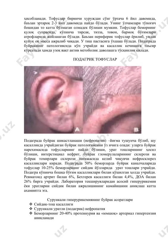 kimyoviy va polyarizatsiyali mikroskopiya usuli bilan tasdiqlangan tofuslarning aniqlanish · keltirilgan 12 simptomdan 6 tasining aniqlanishi · anamnezida bir martadan ko'p o'tkir artrit xuruji · bo'g'im yallig'lanishi kasallikning birinchi kunida maksimumga etadi · monoartrit · jaroxatlangan bo'g'im terisining giperemiyalanishi · oyoqning birinchi panja-barmoq bo'g'imida shish va og'riq · oyoq panjalarining bir tomonlama jaroxatlanishi · tofuslar borligi gumon qilinishi · giperurikemiya · oyoq bo'g'imlarining asimmetrik shishi (rentgenografiya) · eroziyalarsiz subkortikal kistalar (rentgenografiya) · sinovial suyuqlik bakteriologik tekshirilganda manfiy natija differentsial tashxis · psevdopodagra · reaktiv artrit · palindrom revmatizm · revmatoid artrit · o'tkir revmatik isitma · osteoartroz davolash: parxez bilan davolash – spirtli ichimliklar ma'n etiladi, ratsionda purin asosiga boy bulgan maxsulotlar (gusht, balik, dukkakli o'simliklar va ulardan tayyorlangan maxsulotlar mikdori kamaytiriladi. o'tkir podagra xurujini kolxitsin, pirozolon preparatlari, kortikosteroidlar bilan davolanadi. podagrani uzoq davolash uchun quyidagi preparatlar ishlatiladi: 1. yalliglanishga karshi nosteroid vositalar: voltaren (sutkasiga 150 - 200 mg), indometatsin …
