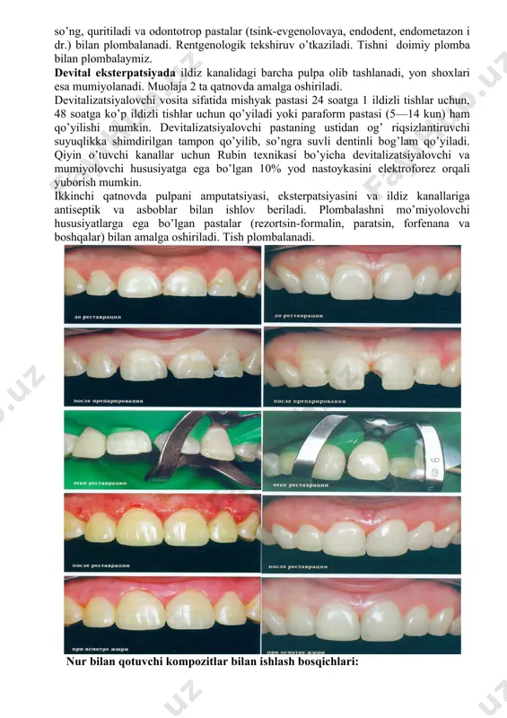 ladi. ildiz pulpasining eksterpatsiyasini pulpa ekstraktor bilan olib tashlanadi. ularni kirish qismiga kiritib, ehtiyotkorlik bilan ildiz kanaliga kiritib, iloji bo’lsa taqalguncha olib borib butun chuqurligi bo’yicha. keyin pulpa ekstraktorni o’qi bo’ylab 1-2 marotaba aylantirib (asbobga bosim bilan ishlash mumkin emas) pulpani yon tishlariga o’ralishi uchun va shu holatda yengillik bilan olinadi. ildiz pulpasini to’liq olishda pulpaekstraktorda ildiz kanali tuzulishiga mos bo’lgan pulpa to’qimasi olinadi. vaziyatga ko’ra muolaja takrorlanadi. kanaldan qon oqmasligi pulpaning to’liq olinganligidan dalolat beradi. kanalga antiseptik va xirurgik ishlov berilganidan so’ng, quritiladi va odontotrop pastalar (tsink-evgenolovaya, endodent, endometazon i dr.) bilan plombalanadi. rentgenologik tekshiruv o’tkaziladi. tishni doimiy plomba bilan plombalaymiz. devital eksterpatsiyada ildiz kanalidagi barcha pulpa olib tashlanadi, yon shoxlari esa mumiyolanadi. muolaja 2 ta qatnovda amalga oshiriladi. devitalizatsiyalovchi vosita sifatida mishyak pastasi 24 soatga 1 ildizli tishlar uchun, 48 soatga ko’p ildizli tishlar uchun qo’yiladi yoki paraform pastasi (5—14 kun) ham qo’yilishi mumkin. devitalizatsiyalovchi pastaning ustidan og’ …