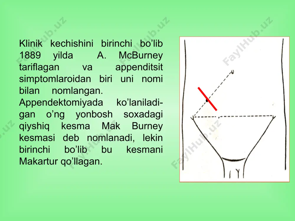endektomiya bosqichlari jarroxlik amaliyotlardan keyingi asoratlar tarqalish ko‘rsatkichi va tavsifi jarroxat asoratlari – 80% qorin ichki – 6% bronx-o‘pka – 4% yurak qon-tomir – 3% boshqalar – 7% oddiy usulda appendektomiya bajarish kamchiliklari har hil teri va mushak nervlarini shikastlanishi; tomirlar jarohati, gematomaga olib kelib, keyinchalik esa - yara asoratlarini keltirib chiqaradi; mushak-aponevrotik to‘qimalarning jarohatlanishi operatsiyadan keyingi churralar hosil bqlishiga olib keladi; qorin bo‘shlig‘ida bajarilgan manipulyasiyalar qorin bo‘shlig‘ida chandiqlanish jarayonining rivoj-lanishiga olib kelishi; diagnostik xatolar foizining ko‘pligi, “kataral” appenditsitlar miqdorining yuqoriligidan ko‘rinib turibdi. o‘tkir appenditsitda endoskopik xirurgiya tarihi 1977 yilda de kok laparosko-piya nazorati va mini-laparotomiya yo‘li bilan appendek-tomiya bajardi 1982 yilda birinchi bo‘lib laparoskopik appendekto-miyani k. semm bajardi (ginekologik kasallikda o‘zgarmagan chuvalchang-simon o‘simtani olib tashladi) 1987 yilda schrieber j.h. birinchi bo‘lib o‘tkir appenditsitda laparoskopik appendektomiya jarroxlik amaliyotini bajardi guruxlardagi o‘tkir appenditsitni morfologik tavsifi kataral flegmonoz gangrenoz oddiy appendektomiya laparoskopik аppеndektomiya laparoskopik appendektomiya variantlari endostepler endo-gia-30 bilan roeder endoliga-turasi bilan …