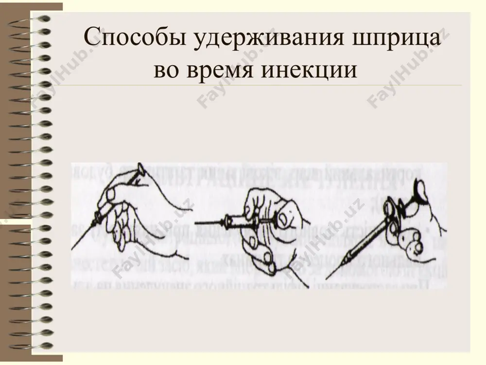в при их повреждении иглой (физиопроцедуры); парез мимических мышц при распространении анестетика на ветви лицевого нерва (проходит самостоятельно); перелом инъекционной иглы вследствие нарушения техники анестезии, чаще в месте перехода ее в канюлю (профилактика: строгое соблюдение техники анестезии. при поломке иглы торусальная анестезия цель: блокада нижнего альвеолярного, язычного и щечного нерва. достигается введением анестетика в клетчатку в области нижнечелюстного валика (torus mandibulae). он расположен в месте соединения костных гребешков: венечного и суставного отростков и находится выше нижнечелюстного отверстия. зона обезболивания: та же что и при мандибулярной анестезии плюс слизистая оболочка с вестибулярной стороны в пределах от середины 5 до середины 7 зуба. аподактильный (безпальцевой) способ мандибулярной анестезии а.ю. верлоцьким ментальная анестезия. цель: блокада подбородочного нерва. зоны обезболивания: мягкие ткани подбородка и нижней губы; 1 - 6 зубы, костная ткань альвеолярного отростка и слизистая оболочка с вестибулярной стороны в пределах анестезия на нижнечелюстном возвышении (торусальная анестезия) м.м. вейсбрему нижнюю челюсть нижньоальвеолярного, языкового …