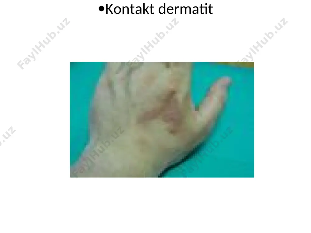 a o’lim bilan tugaydi. gistolik: epidermisda nekrotik o’zgarishlar, akantoliz kuzatiladi va epidermis qavati ko’cha boshlaydi. epidermis ichi va ostida pufaklar paydo bo’ladi. donador va muguz qavatning bo’kishi, dermada limfostit, eozinofillar neytrofillardan iborat infiltrastiya kuzatiladi. toksidermiyalarda terida bo’ladigan o’zgarishlar qavarchiq-ko’p miqdordagi urtikar toshmalarning toshishi dogli-papulyoz toshmalarning kuzatilishi dorilarning fiksastiyalangan doglari lixenifikastiya ko’rinishida eritemalar purpuralar; qon quyilishlar pufak va pufakchalar. penistillin bilan davolangan bemorda kvinke shishi ampistillin bilan davolangan bemorda toshmalar nifedepin bilan davolangan bemorning oyoqlarida shish fenition chaqirgan allergik toshma fenolftalein qabul qilgandan keyingi fiksatsiyalangan toksidermiya tetrastiklin qabulidan keyingi fiksatsiyalangan toksidermiya fenilbutazondan keyingi fiksatsiyalangan toksidermiya stivens-djonson sindromi laella sindromi laella sindromi amiodaron qabulidan keyingi disxromiya monosiklindan keyingi disxromiya varfarinli nekroz geparindan keyingi nekroz pishgan teri sindromi xayz davrida ishlatilgan tampon natijasida kelib chiqgan toksik shok va teri o’zgarishlari medikamentoz toksikodermiya toksikodermiya toksidermiya toksikodermiya sulfanilamidli eritema ekzemaning eritematoz bosqichi medikamentoz toksikodermiya. eritematoz-skvamoz shakli. seboreyali dermatit seboreyali dermatit davolash usullari etiologik faktorning ta’sirini …