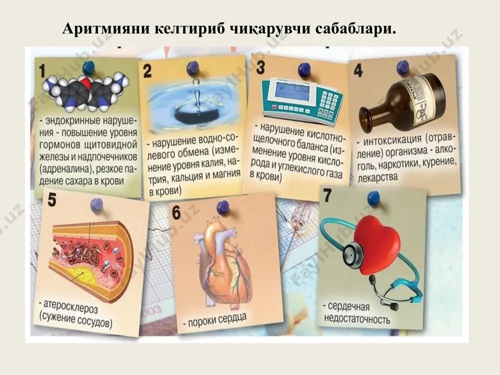 ан юқорида, т тишча мусбат (+) бўлади. ўнг тармоқларда - ііі ст.уз.avr кучайтирилган уз. v1- v2 кўкрак уз.да qrs комплекси r тишча ҳисобига кенгайган катта м кўринишида , s-t изолиниядан пастда т тишча манфий (-) бўлади. ўнг гисс оёғини нотўлиқ қамали. экгда qrs кенгайиши ўнг қоринча гипертрофияси белгиларига ўхшаб кетади, фақат qrs давомийлиги 0,12 секундгача кенгайган бўлади. чап тармоқларда -і ст.уз. avl кучайтирилган уз. v5- v6 кўкрак уз.да qrs комплекси s тишча ҳисобига кенгайган, s-t изолиниядан юқорида, т тишча мусбат (+) бўлади. ўнг тармоқларда - ііі ст.уз.avr кучайтирилган уз. v1- v2 кўкрак уз.да qrs комплекси r тишча ҳисобига кенгайган катта м кўринишида, s-t изолиниядан пастда т тишча манфий (-) бўлади. гетеротроп эктопик ритм бузилиши. пароксизмал тахикардия-бирданига бошланиб,шунингдек бирданига тугалланадиган юрак қисқариши тезлашиши хуружига айтилади. пт-хуружини ўзига хослиги юрак ритмини бирданига тезлашишидир.1 минутда 130-300 тагача юрак қисқаради. синфланиши: 1.суправентрикуляр пт : а) пт –бўлмача, б)ав тугун вентрикуляр пт: а) чап қоринча; …