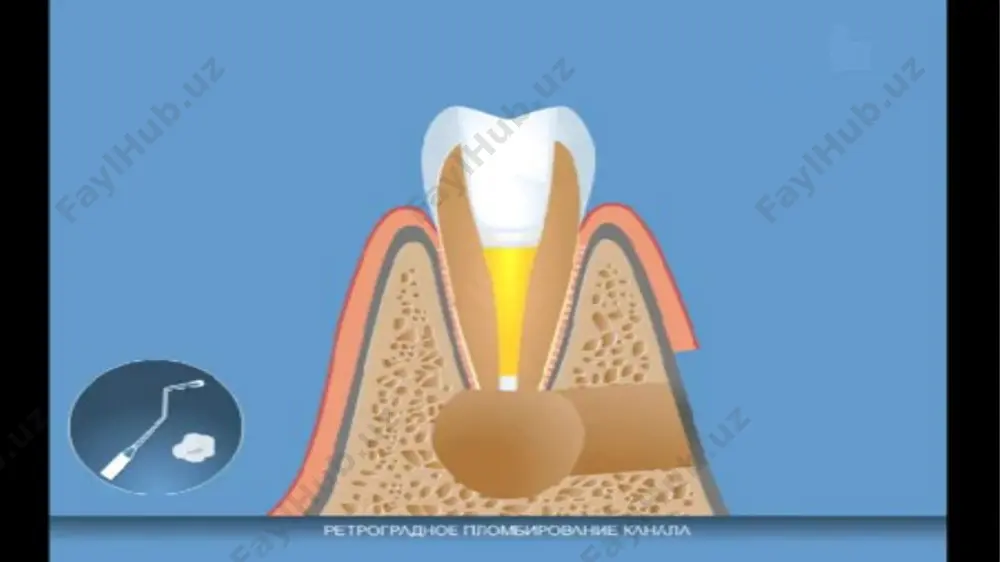 surunkali periodontitni konservativ-xirurgik davolash usullari - Page 5