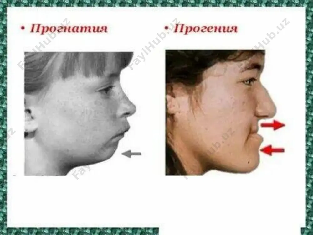 р) нинг турли усуллари қўлланилади. бу усуллар баъзи бир камчиликларга эга: тиш олишнинг мажбурлиги; кўпинча лунж соҳаларида юмшоқ тўқималарнинг ортиқча ҳосил бўлиши ва шу туфайли юзнинг шишиб кетиши; пастки жағ қон томир-нерв тутамининг шикастланиш эҳтимоли мавжудлиги; пастки жағ бурчагининг ўзгармаслиги ва фрагмент регенерациясига шароитнинг етарлича эмаслиги. суякдаги остеотомия соҳаси пастки жағ функцияси вақтида босимга бардош беролмаслиги сабабли, очиқ тишлар нисбати шаклида асоратланиши мумкин. пастки жағ бурчаги ва шохи соҳасидаги вертикал ёки горизонтал остеотомия операциялари энг кўп тарқалган хирургик операциялари сирасига шунингдек, пастки жағ танаси ва шох қисмларидаги деформацияларни бартараф этишда хирургик стоматология кафедрасида ишлаб чиқилган шиша кристалл (биоситалл) материалидан кенг фойдаланилмоқда ҳозирги вақтда кўпчилик муаллифлар эътибори бурчак ва шох соҳаларида ўтказиладиган ясси (кортикал пластинкалараро) остеотомия операциясига қаратилган, бунда суяк фрагментларидаги тегиб турадиган (яра) юзаларининг майдони нисбатан катта, чакка - пастки жағ бўғимининг муносабати сақланади, даволаш муддати қисқаради, яхши натижа кузатилади. келтирилган усуллар маълум даражада универсал ҳисобланади, чунки улар турли патологияларда: …